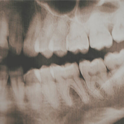 ALL ABOUT DENTAL X-RAYS