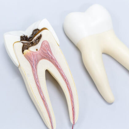 DENTAL CAVITIES?