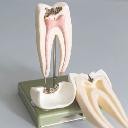 ROOT CANAL 101