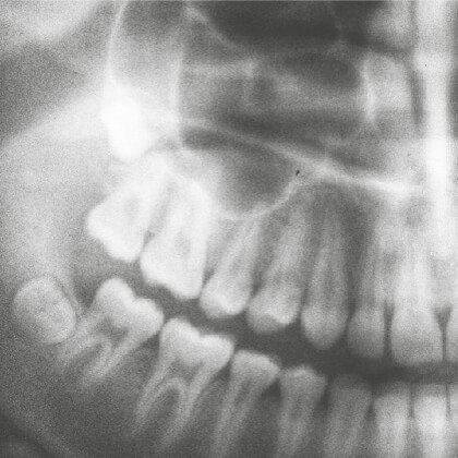 EST CE QUE JE DOIS EXTRAIRE MES DENTS DE SAGESSES ?