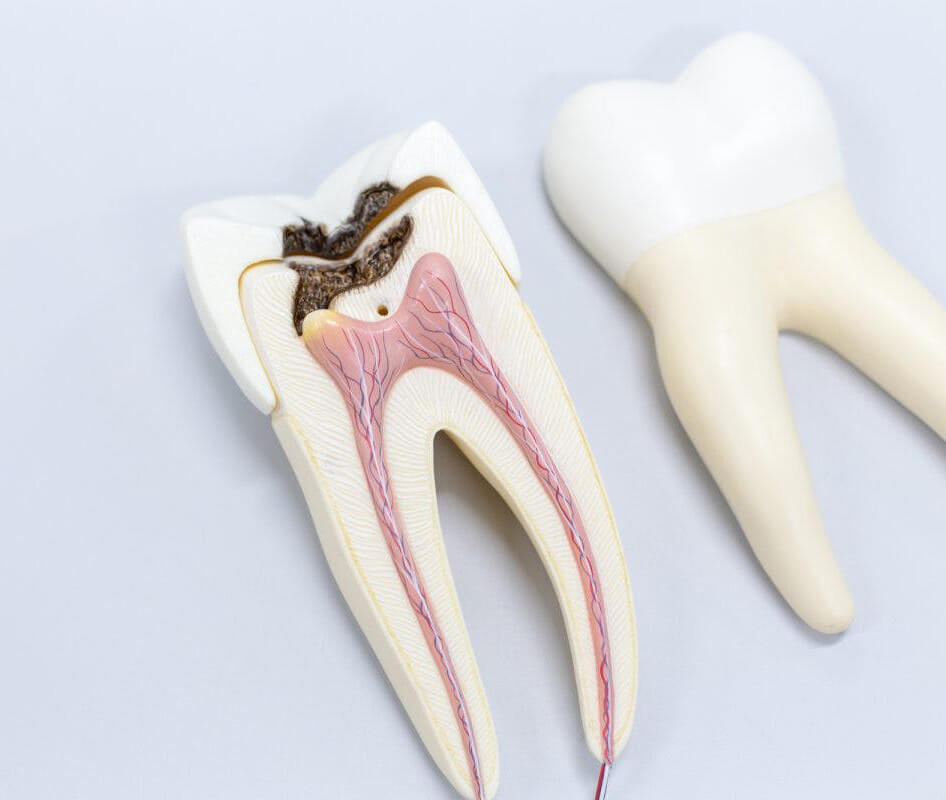 DENTAL CAVITIES?