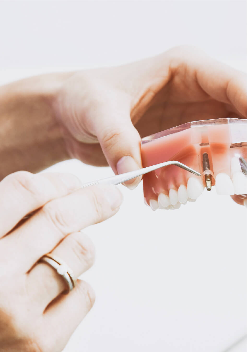 ALL ABOUT DENTAL IMPLANT MONTREAL