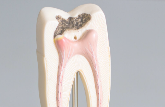 ROOT CANALS